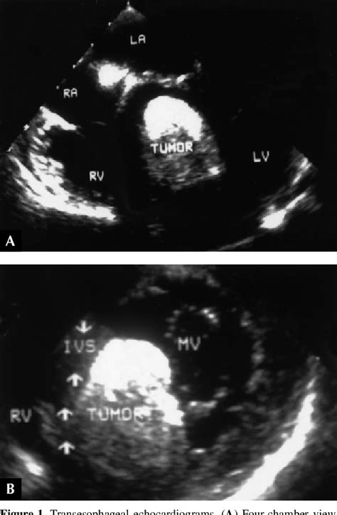 lipoma of the left ventricular